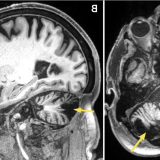 脑卒中后小脑病变MRI.